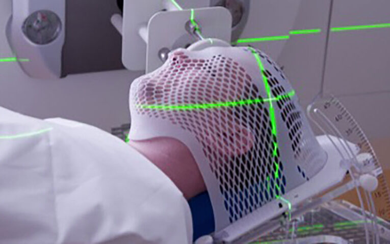 Uso de radioterapia para tratar tumores cerebrales